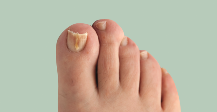 Nail cream fungal infection