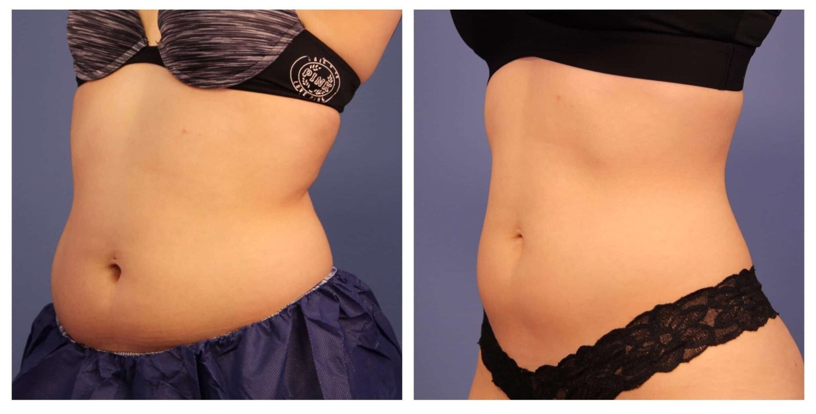 How Much Does CoolSculpting Cost? - PiticStyle