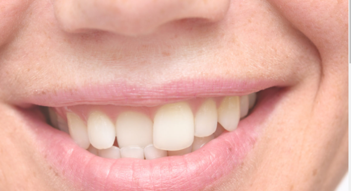 How Orthodontists Can Straighten Crooked Teeth